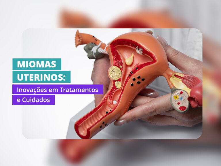 Miomas Uterinos Causas Tratamentos Avançados E Impacto Na Saúde